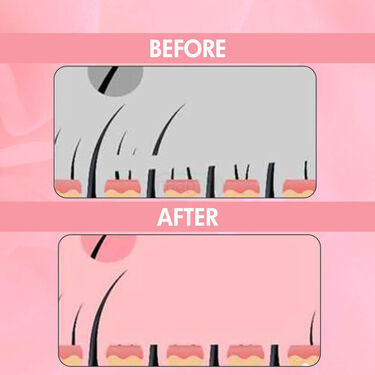 Painless Hair Remover Buy 1 Get 1
